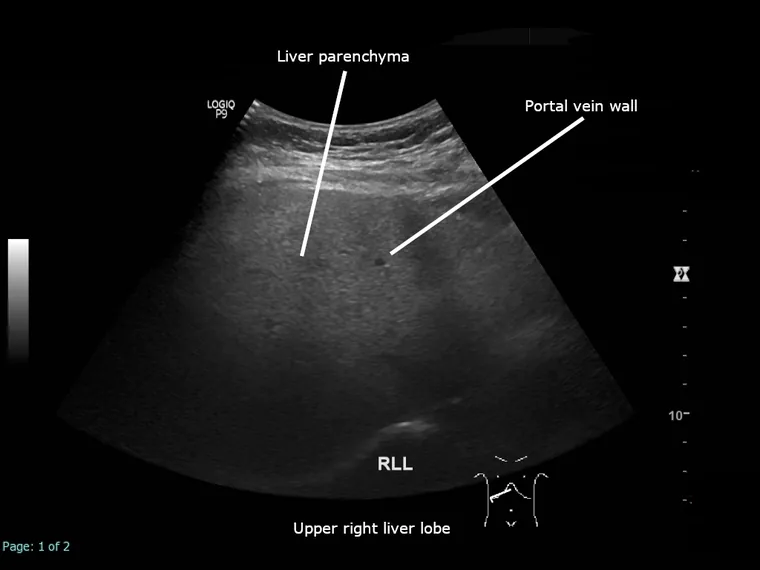 Ultrassonografia de referência de esteatose hepática